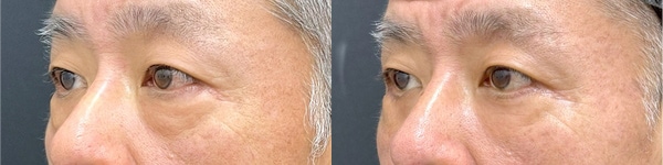 鼻整形のベスト症例写真