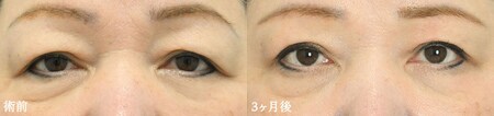 二重切開法のベスト症例写真