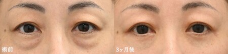 二重切開法のベスト症例写真