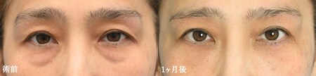 二重切開法のベスト症例写真