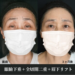 二重切開法のベスト症例写真