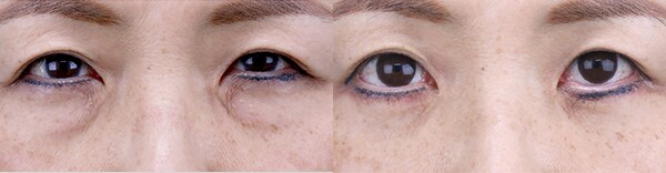 目元切開のベスト症例写真