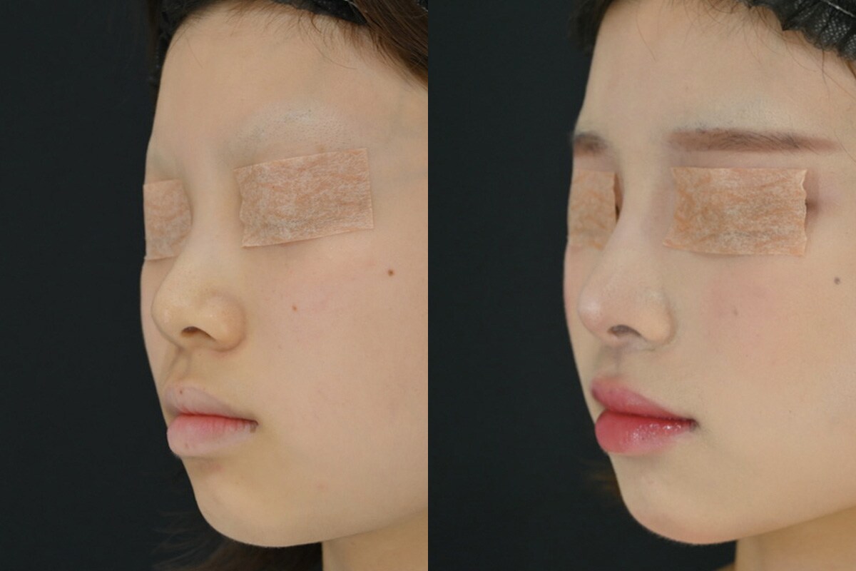 鼻整形のベスト症例写真