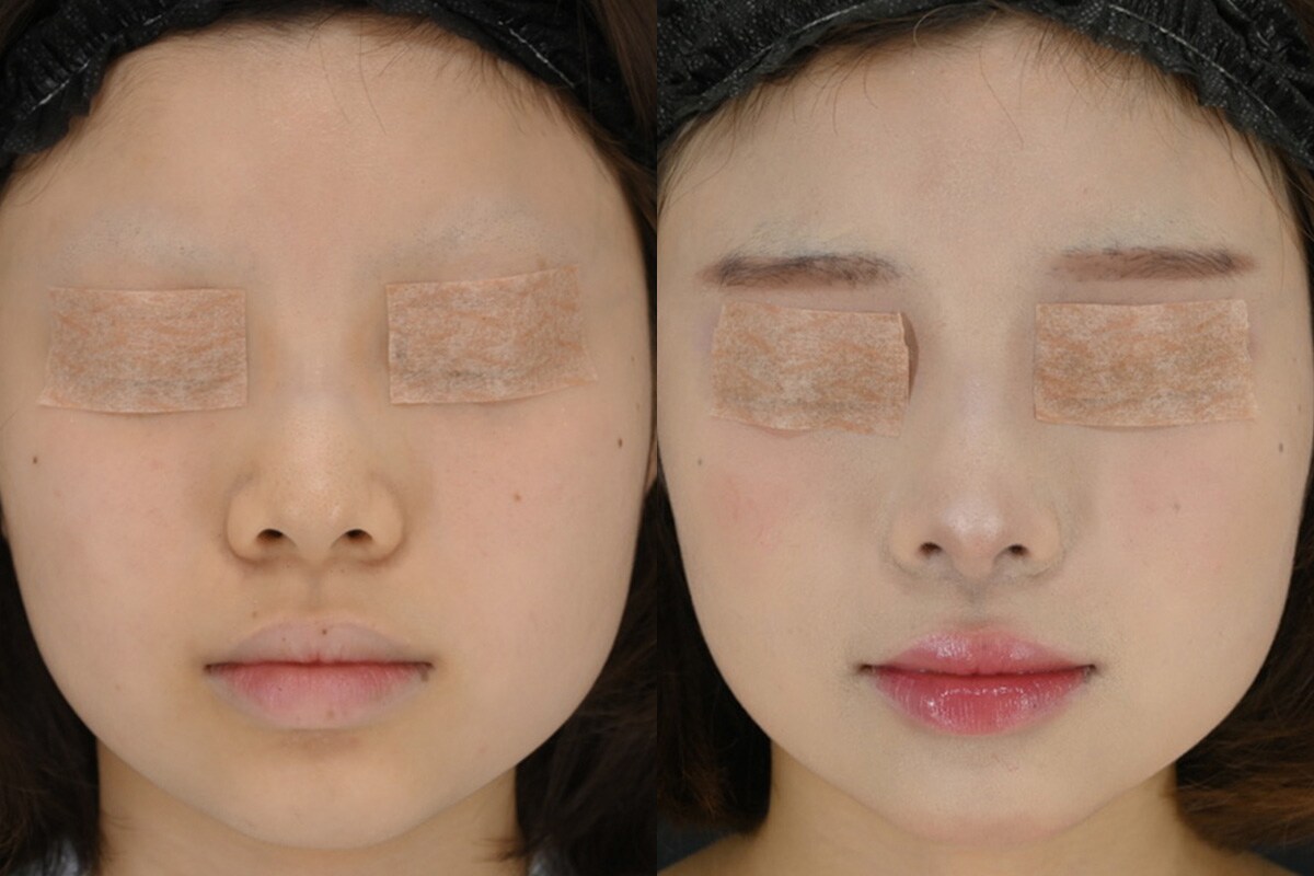 鼻整形のベスト症例写真