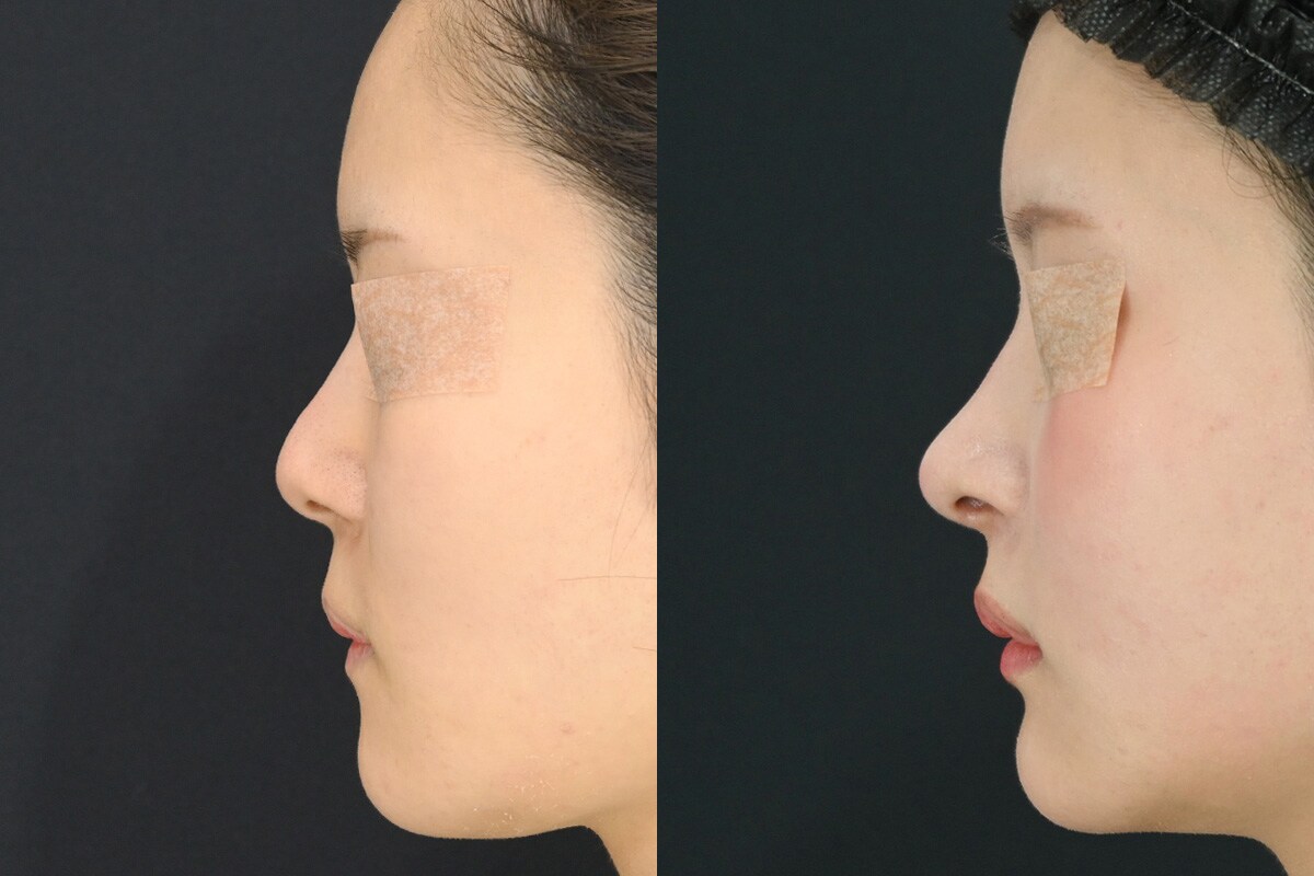 鼻整形のベスト症例写真