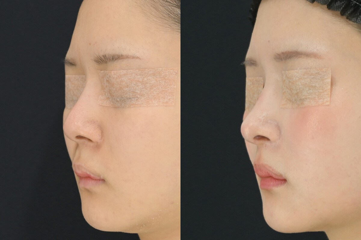 鼻整形のベスト症例写真
