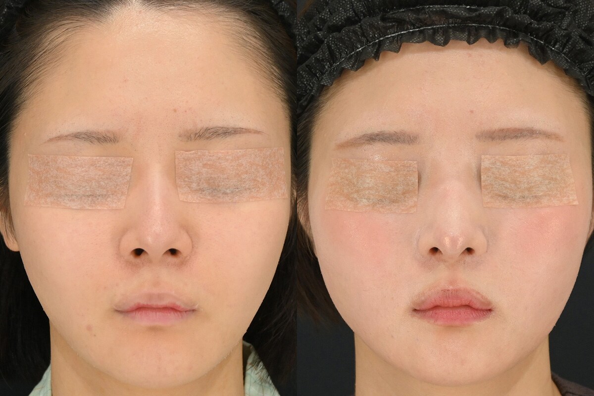 鼻整形のベスト症例写真