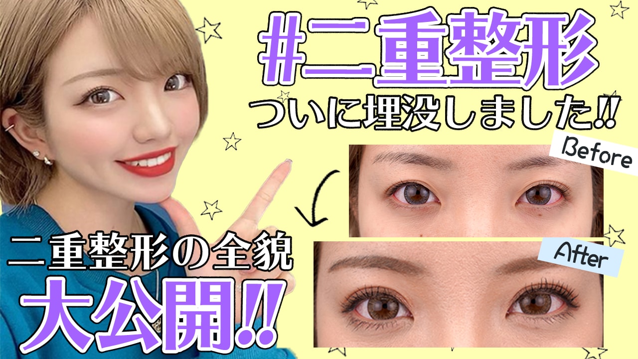 二重整形しました
