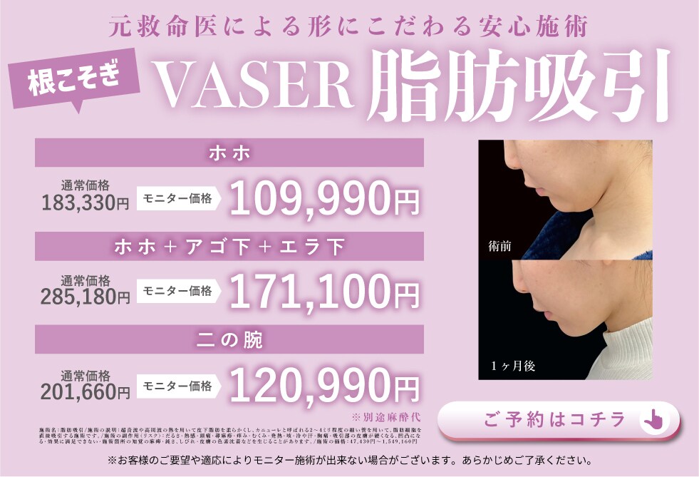 VASER脂肪吸引