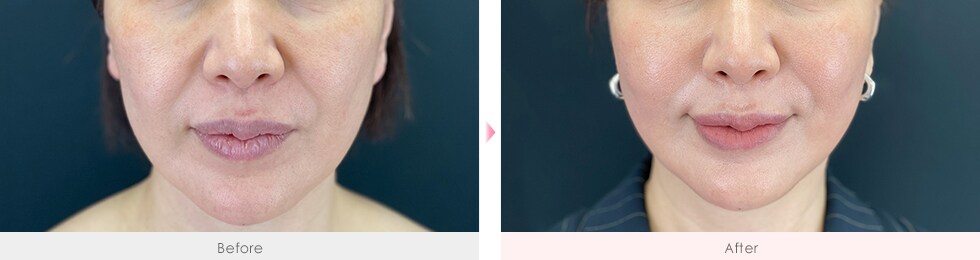 症例写真1