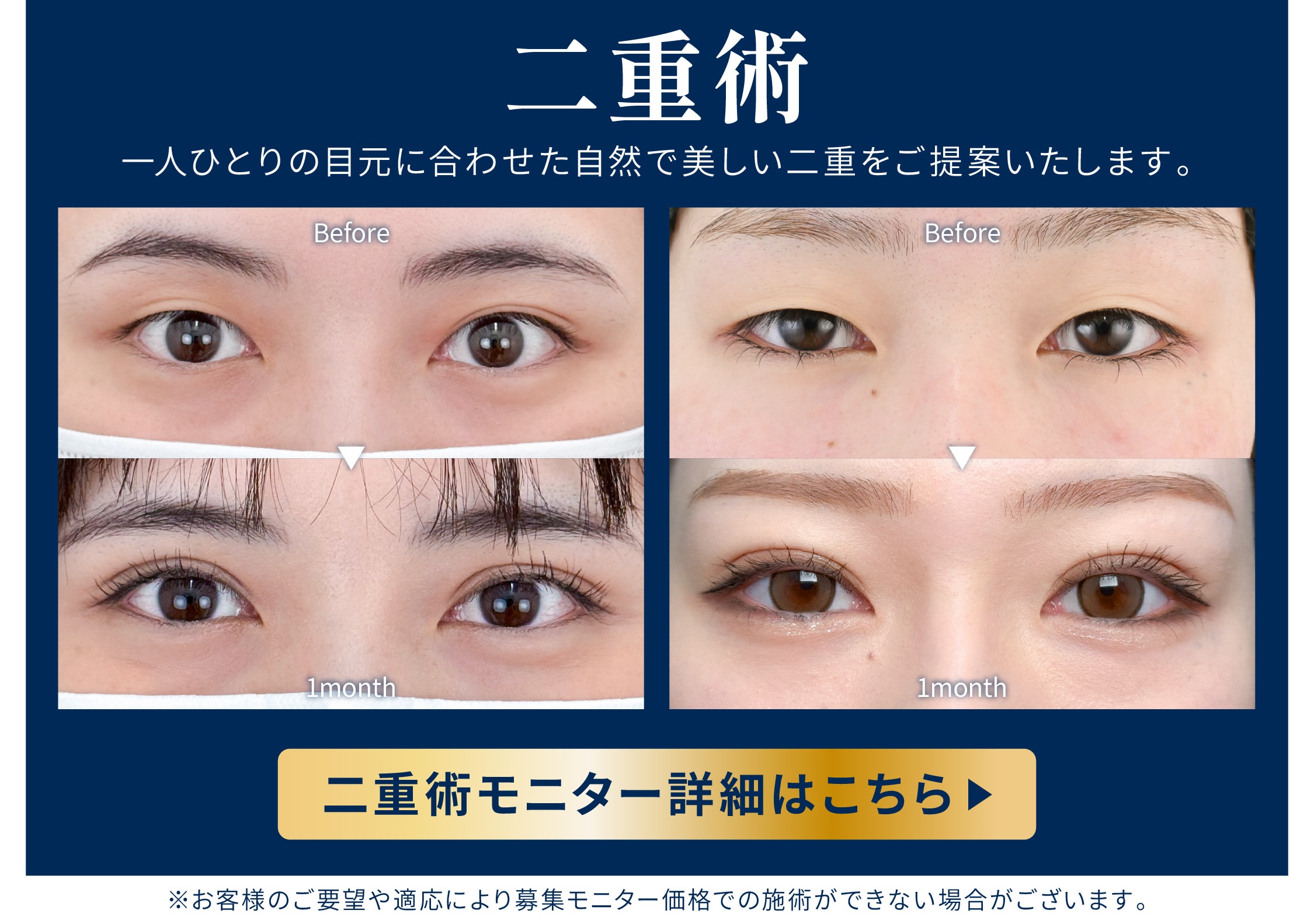 二重術モニター募集