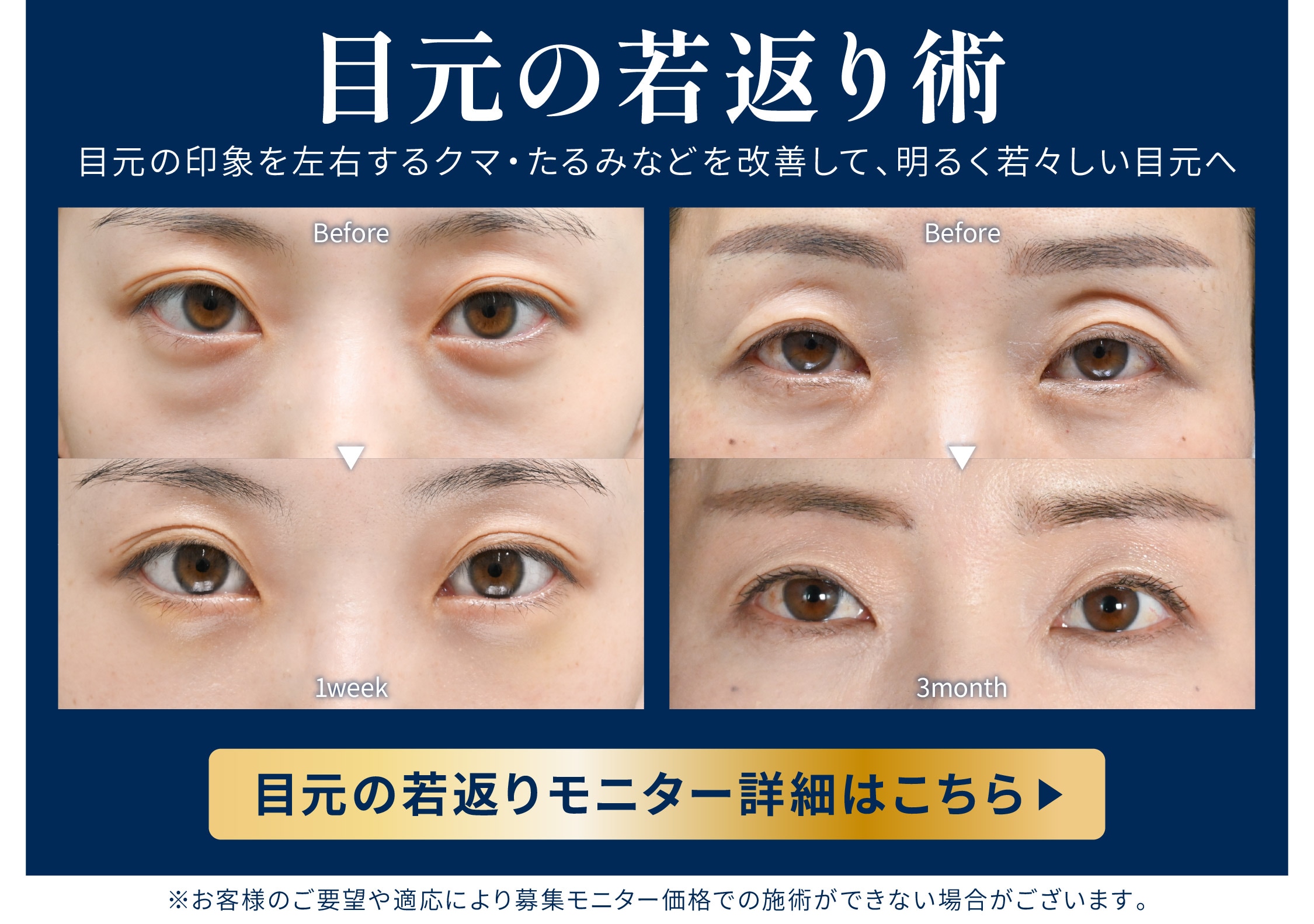 目元の若返りモニター募集