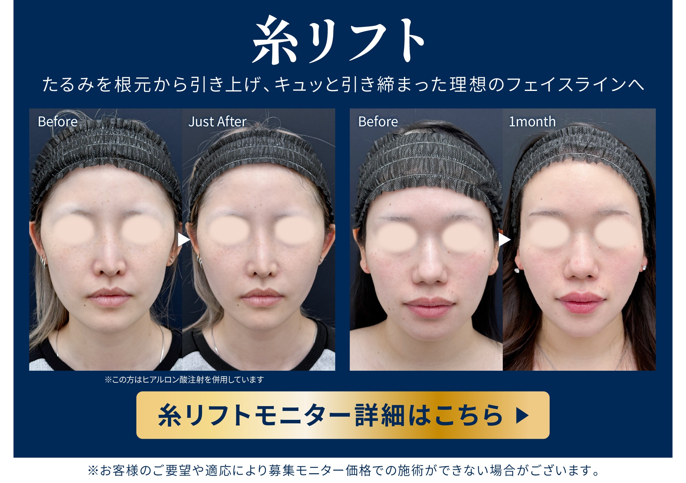 糸リフトモニター募集