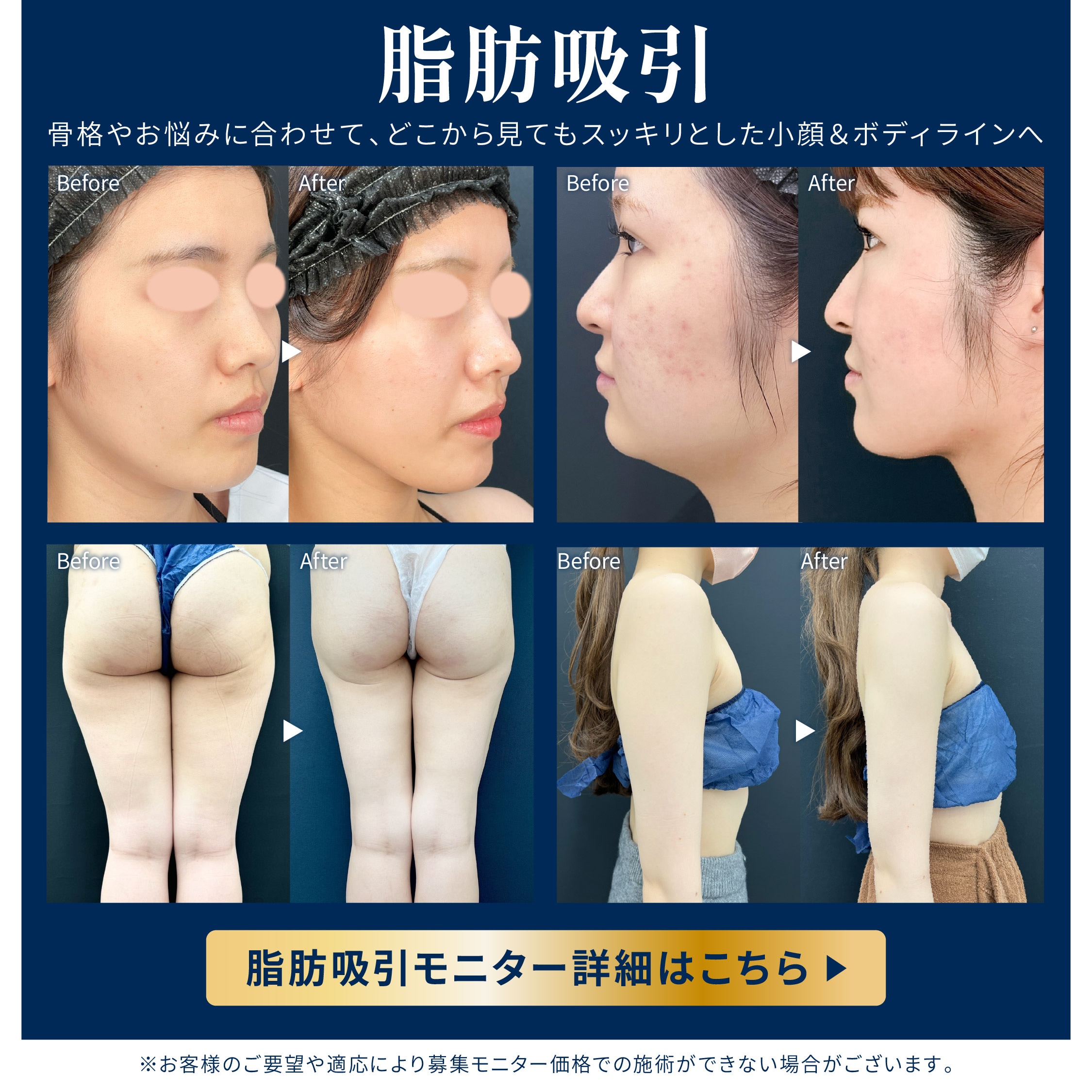 脂肪吸引モニター募集