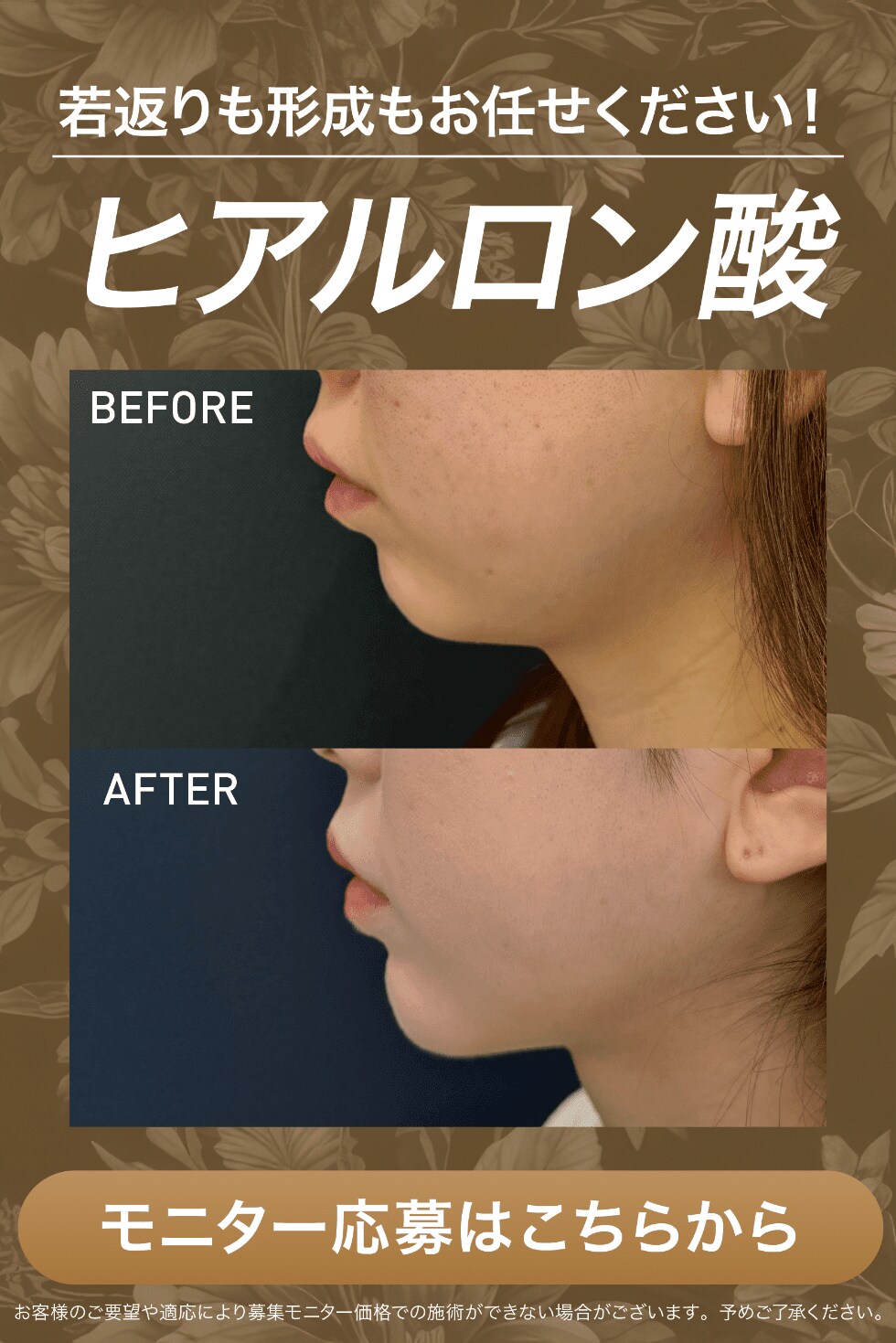 ヒアルロン酸モニター