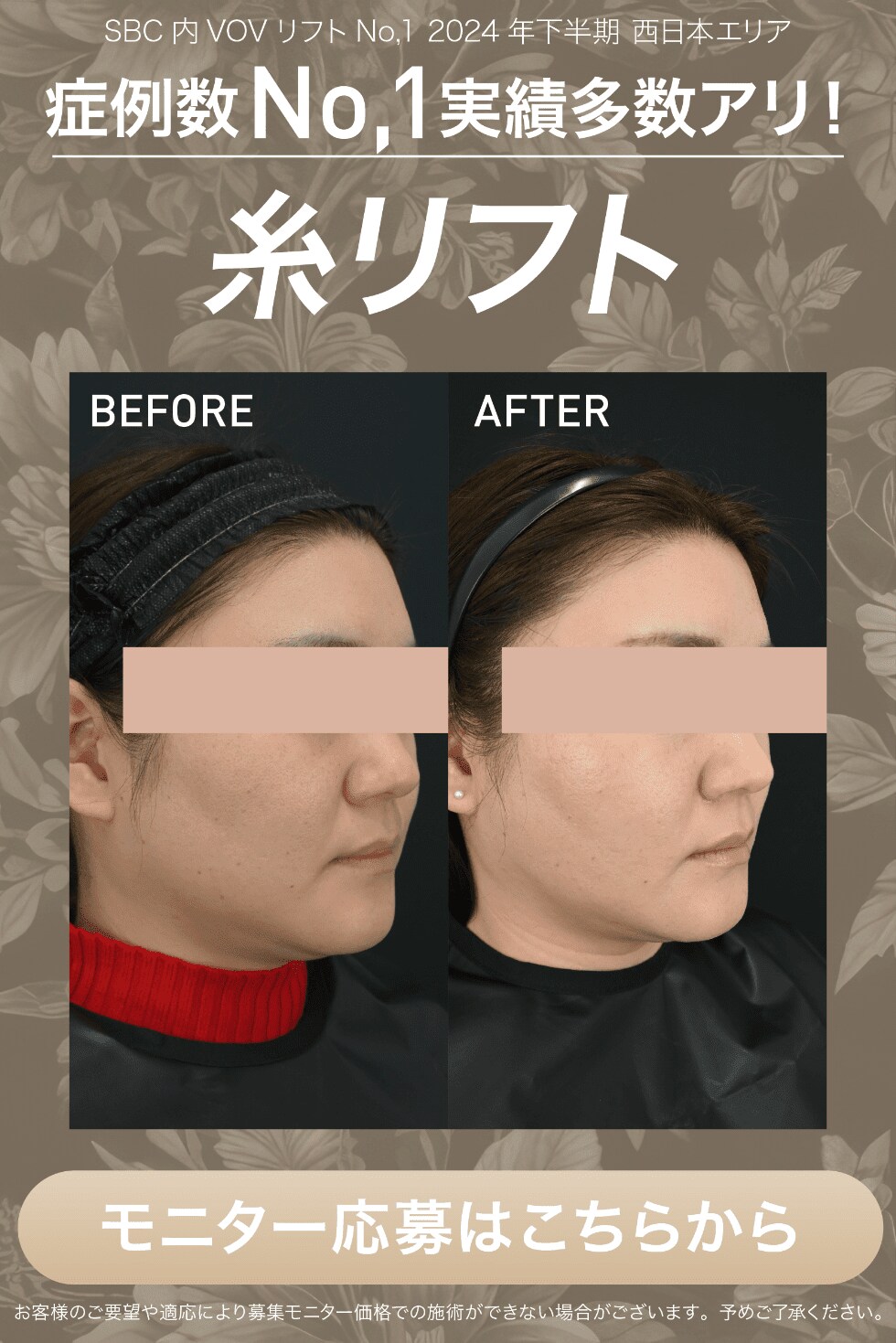 糸リフトモニター