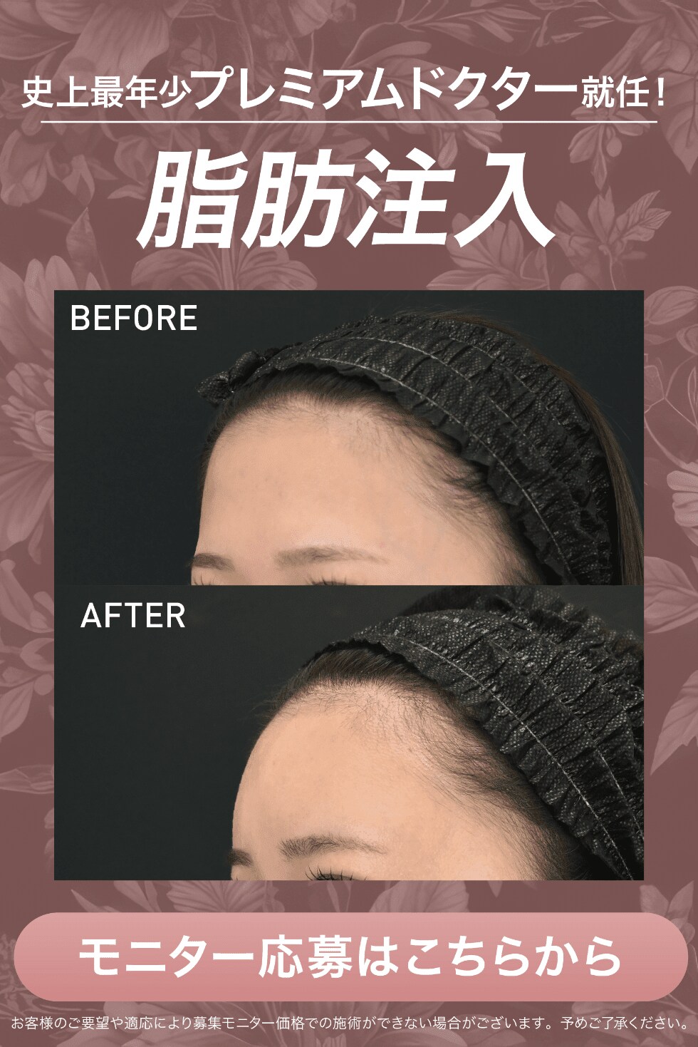 脂肪注入モニター
