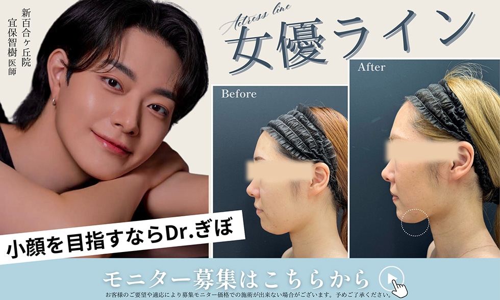 糸リフト