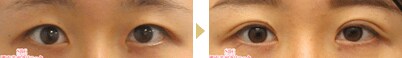 二重幅を広げた症例01