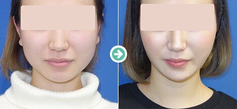 脂肪吸引