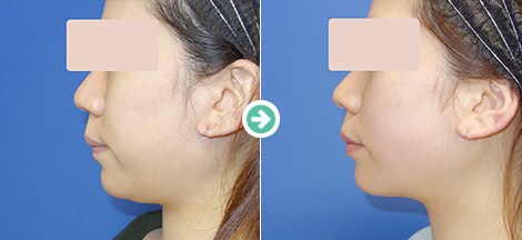 脂肪吸引