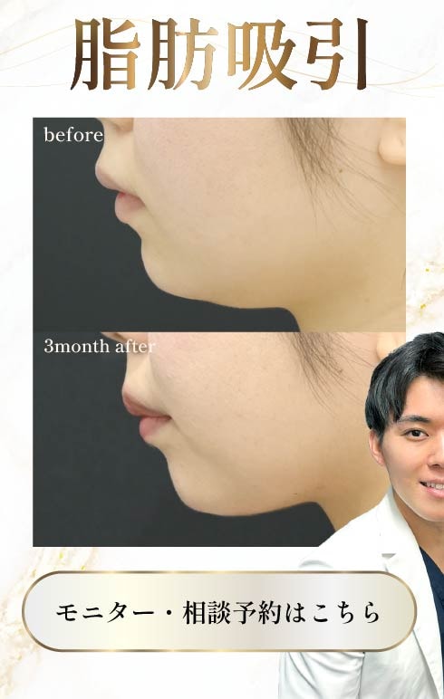 美ボディ脂肪吸引