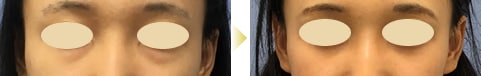 目の下の切らないクマ・たるみ（ふくらみ）取り症例写真02