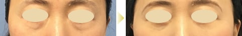 目の下の切らないクマ・たるみ（ふくらみ）取り症例写真03