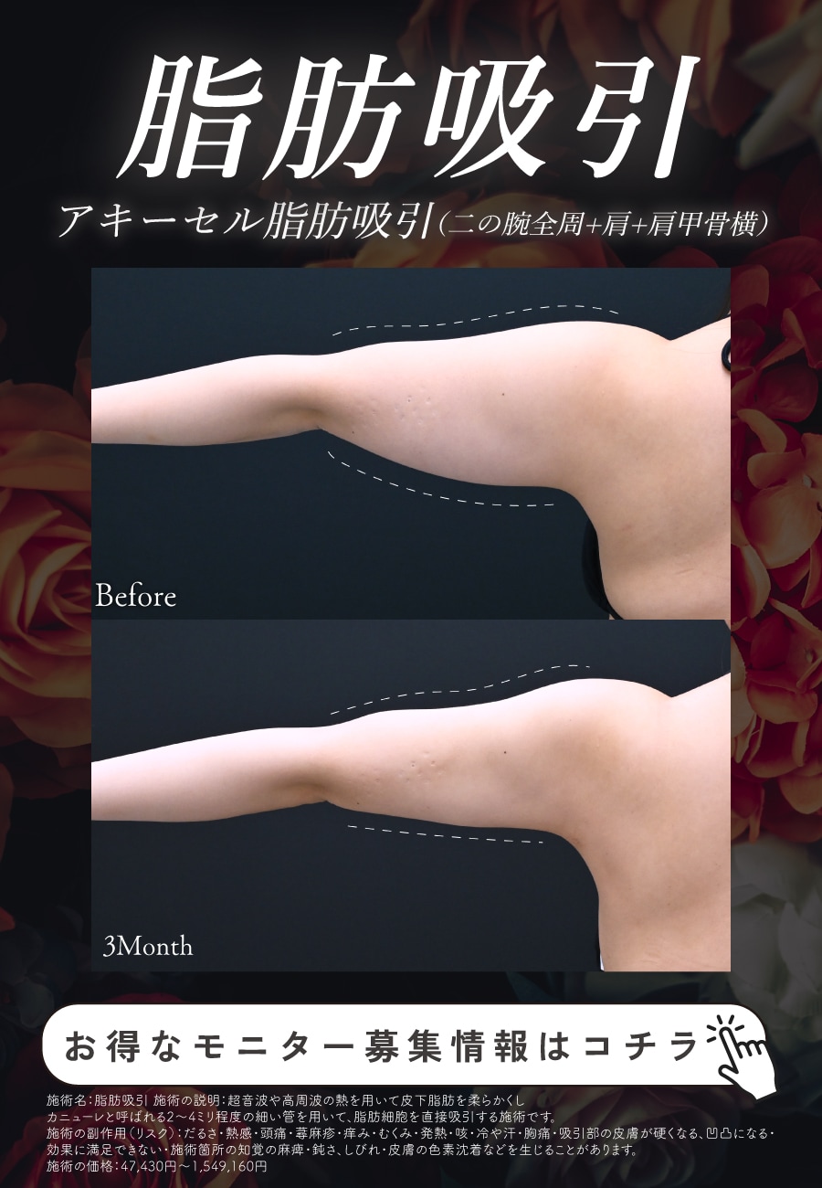 脂肪吸引
