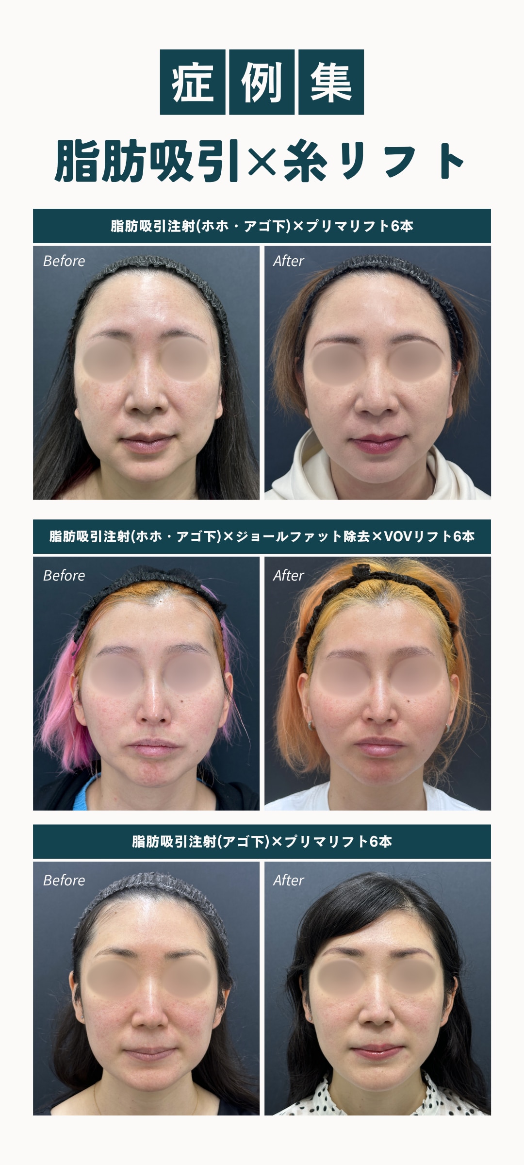 症例集 脂肪吸引×糸リフト