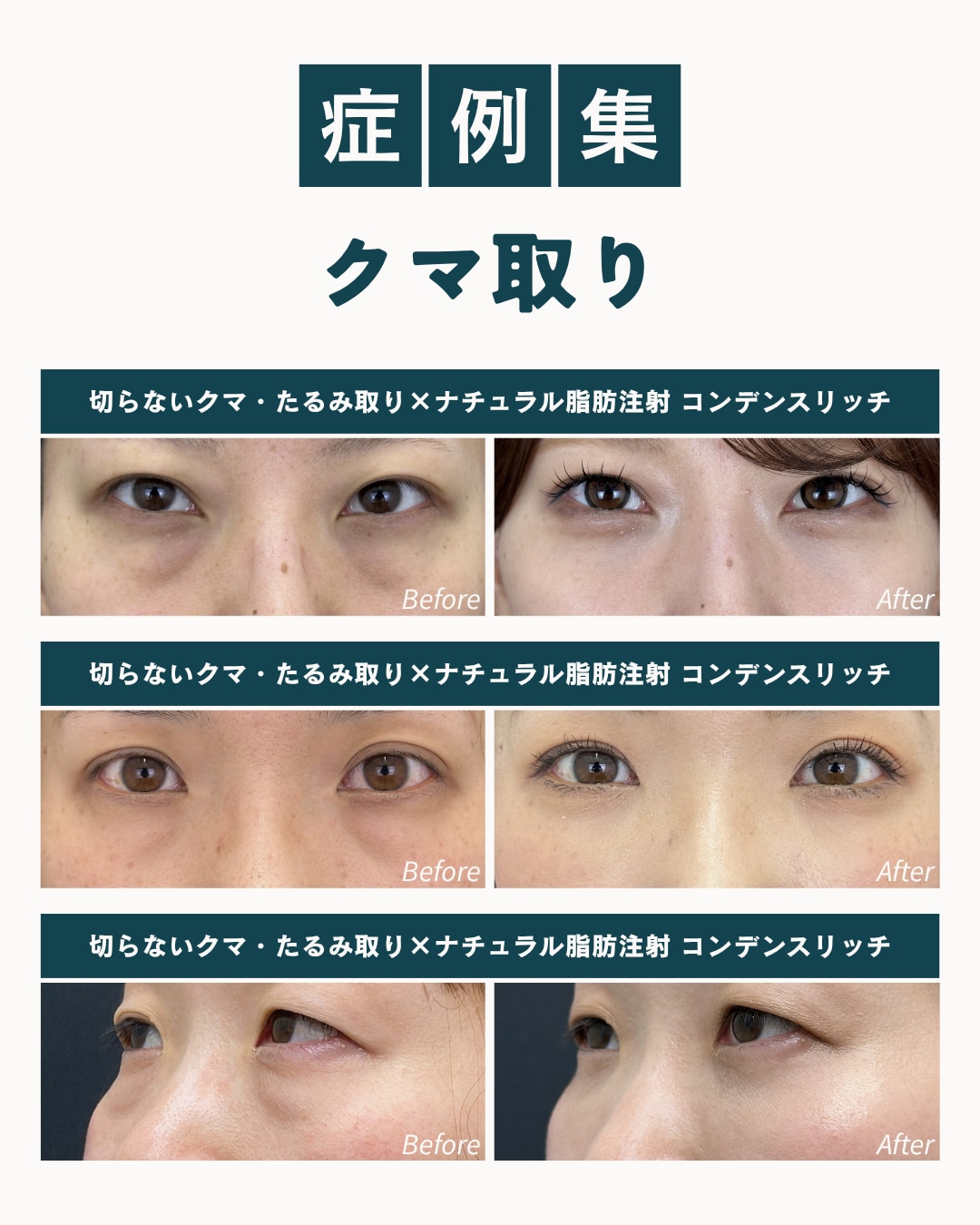 症例集 クマ取り