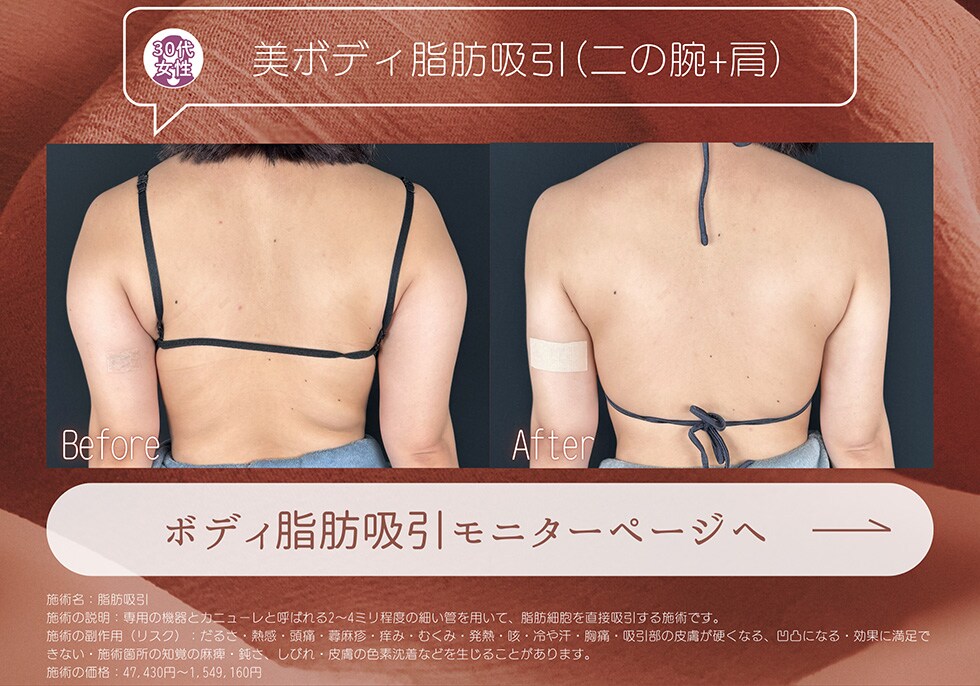 美ボディ脂肪吸引