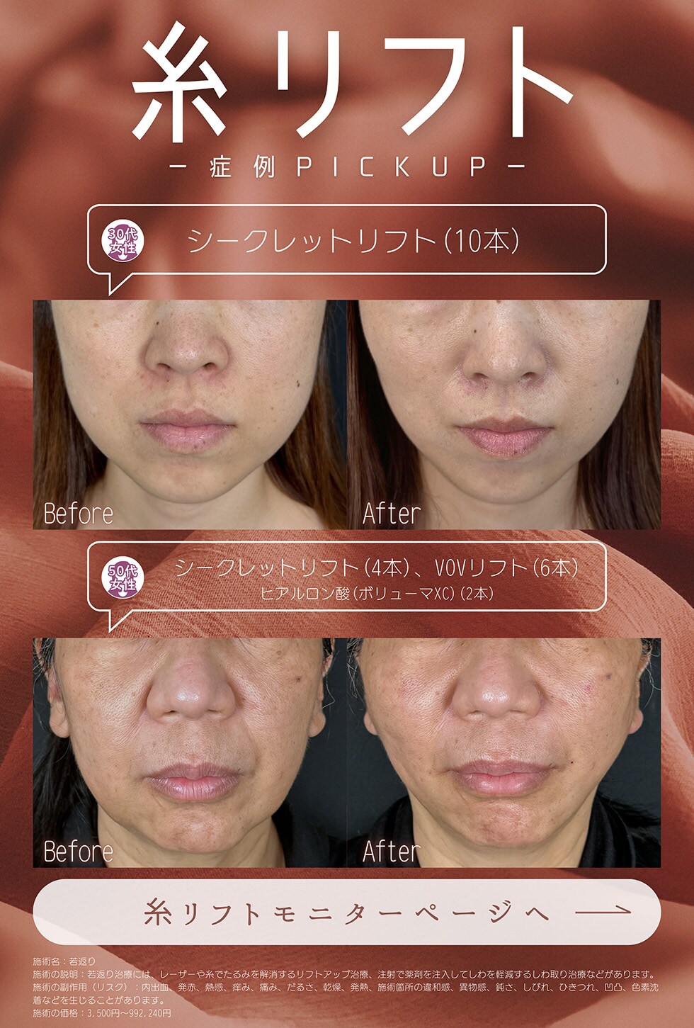 糸リフト