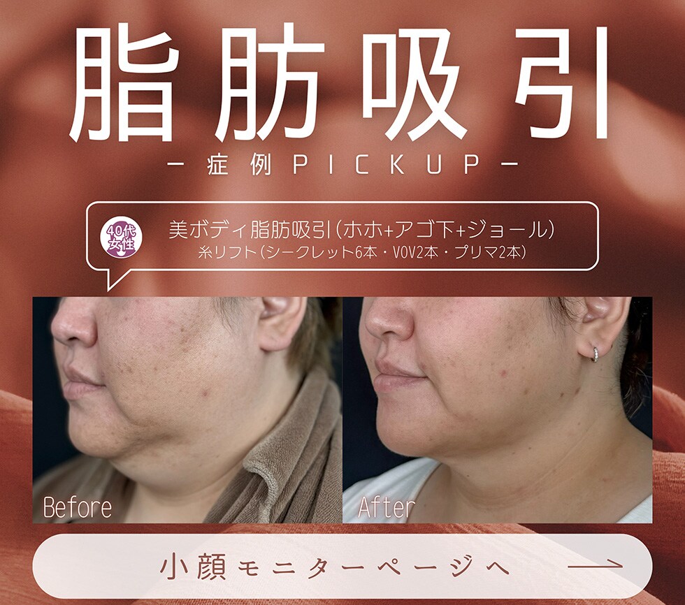 脂肪吸引