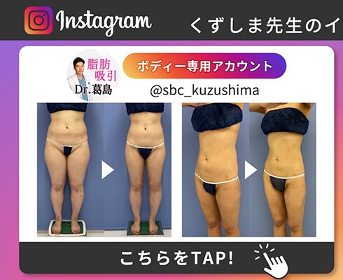 Instagram 体の脂肪吸引