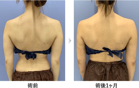 ベテランdr が叶える二の腕美人特集 美容整形 美容外科 美容皮膚科なら湘南美容クリニック 公式 ベテランdr が叶える二の腕美人特集 美容整形 美容外科 美容皮膚科なら湘南美容クリニック 公式