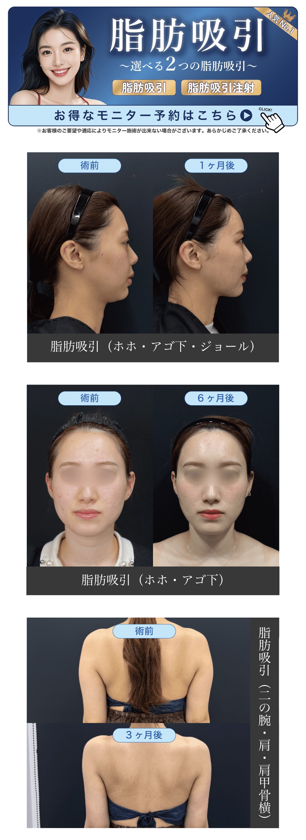 脂肪吸引モニター予約
