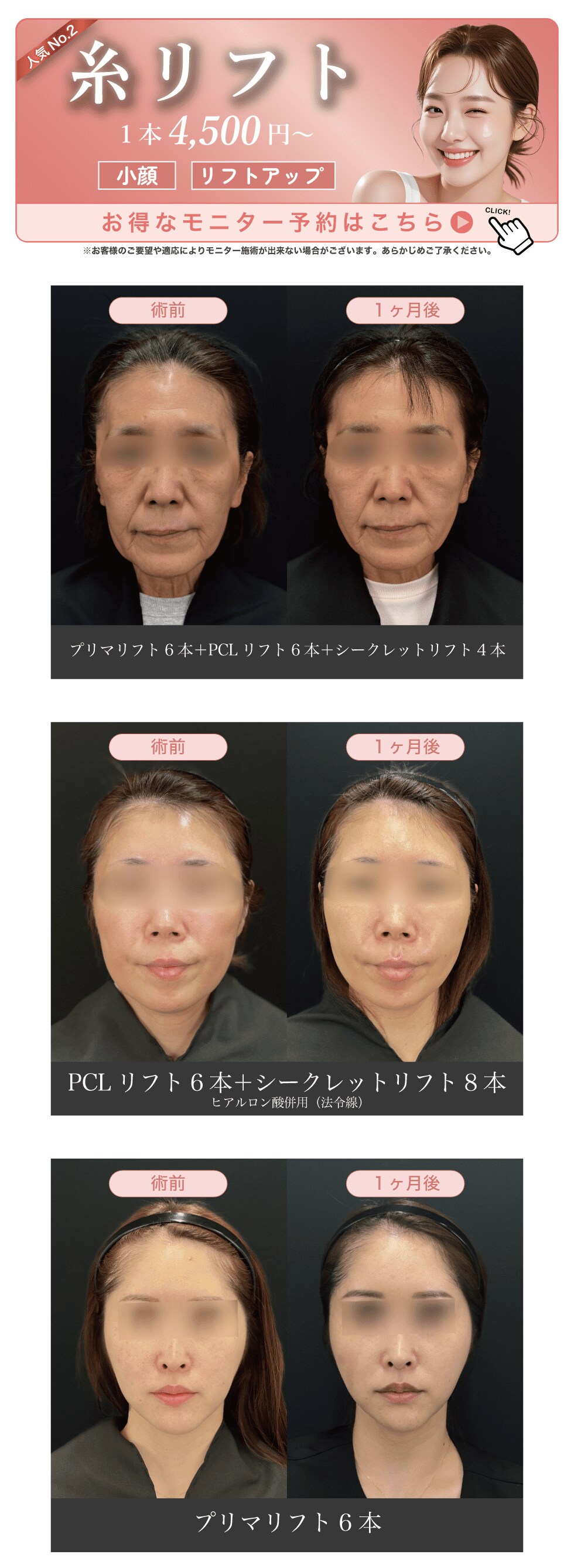 糸リフトモニター予約