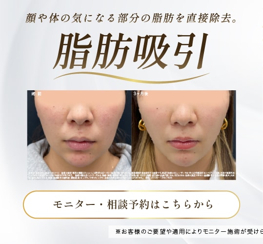脂肪吸引