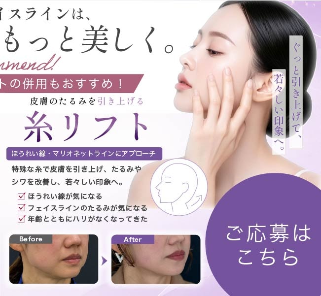 糸リフト
