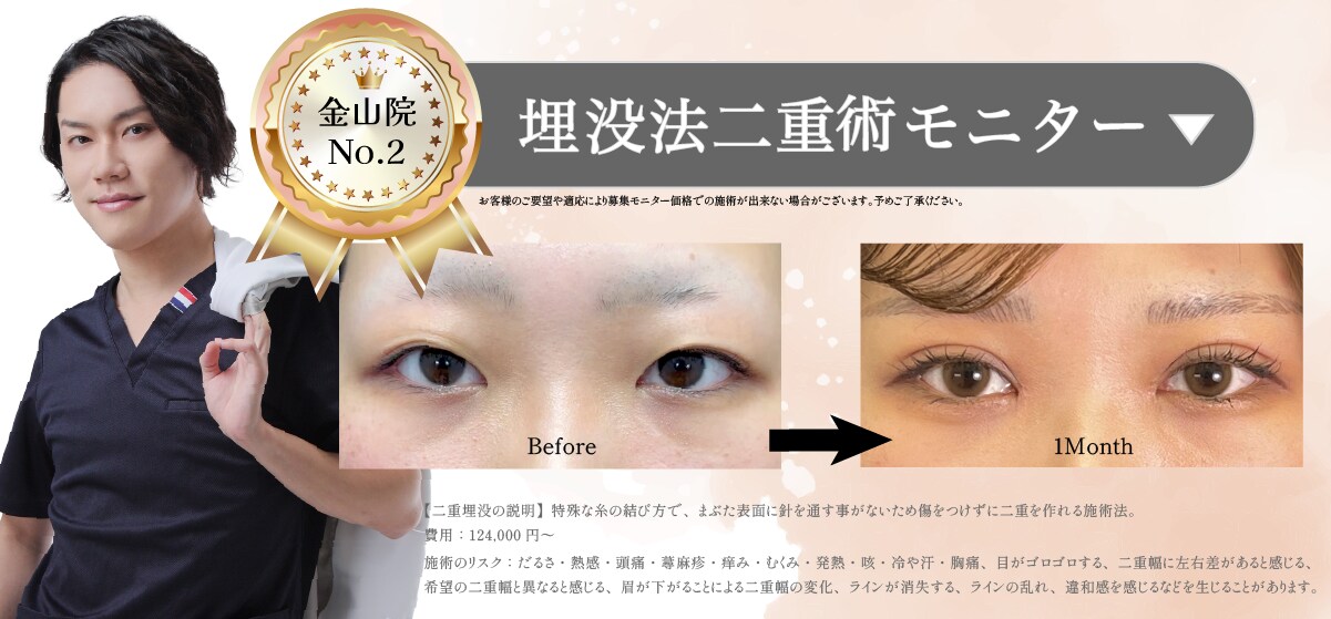 埋没法二重術モニター