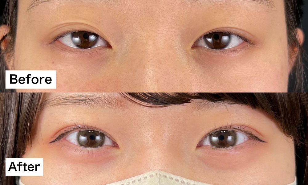 二重術の症例写真