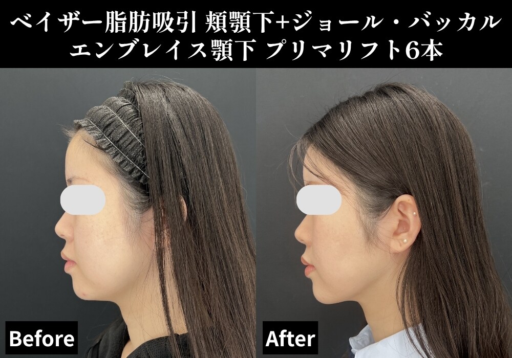 脂肪吸引の症例写真