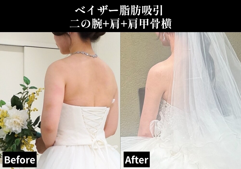 脂肪吸引の症例写真