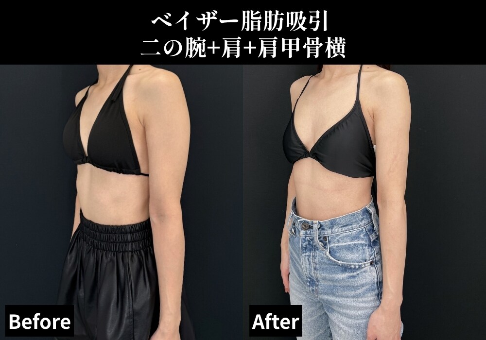 脂肪吸引の症例写真