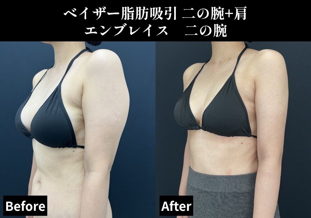 脂肪吸引の症例写真