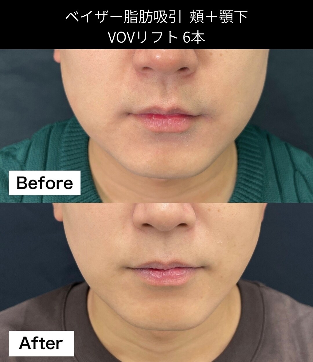 脂肪吸引の症例写真