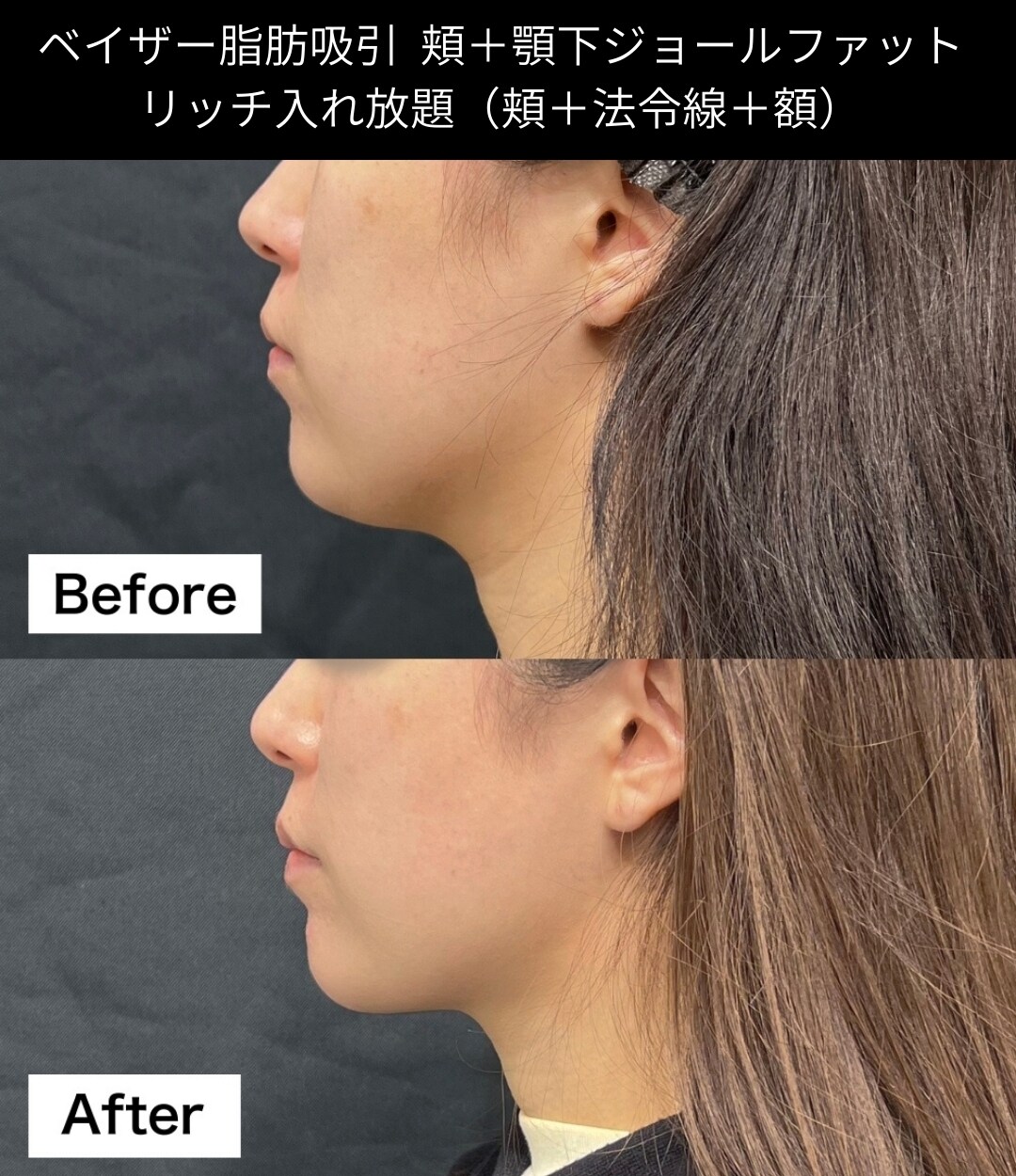 脂肪吸引の症例写真