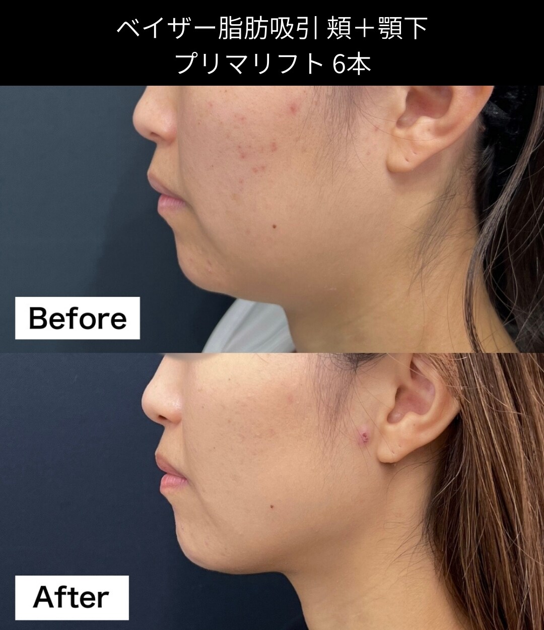 脂肪吸引の症例写真