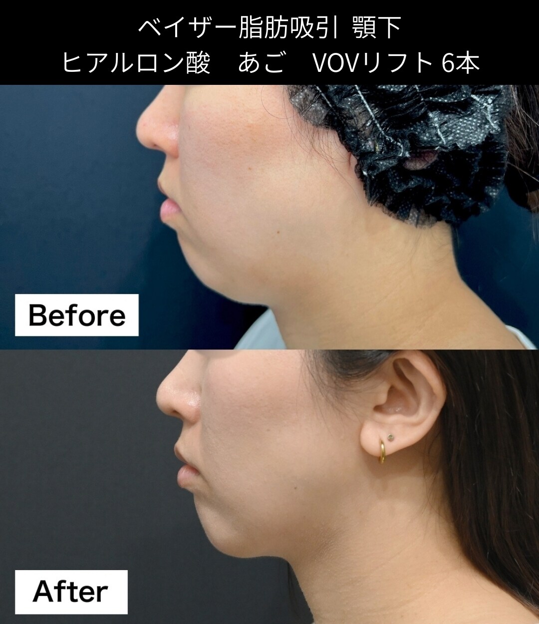 脂肪吸引の症例写真
